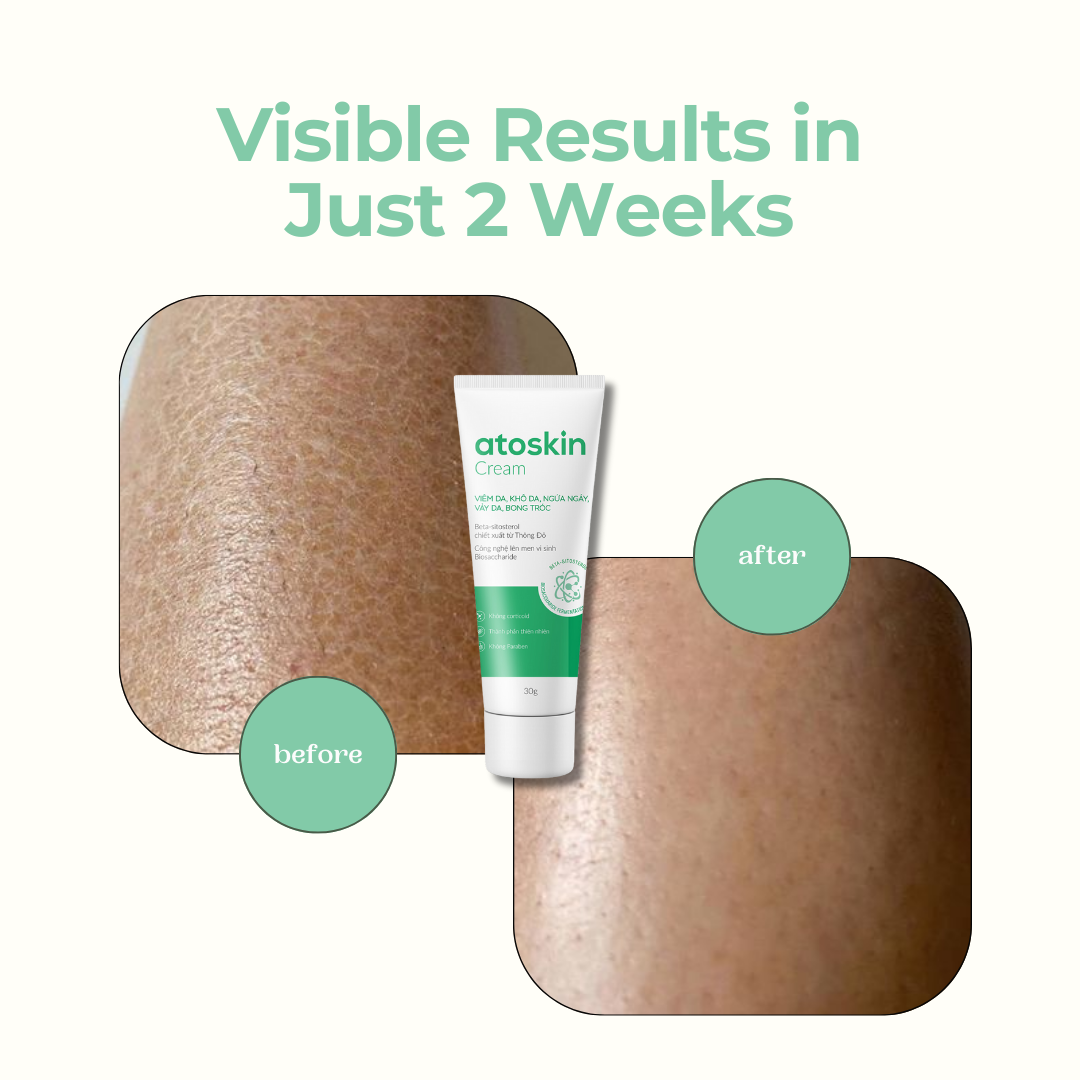 Atoskin Cream, Eczema Cream