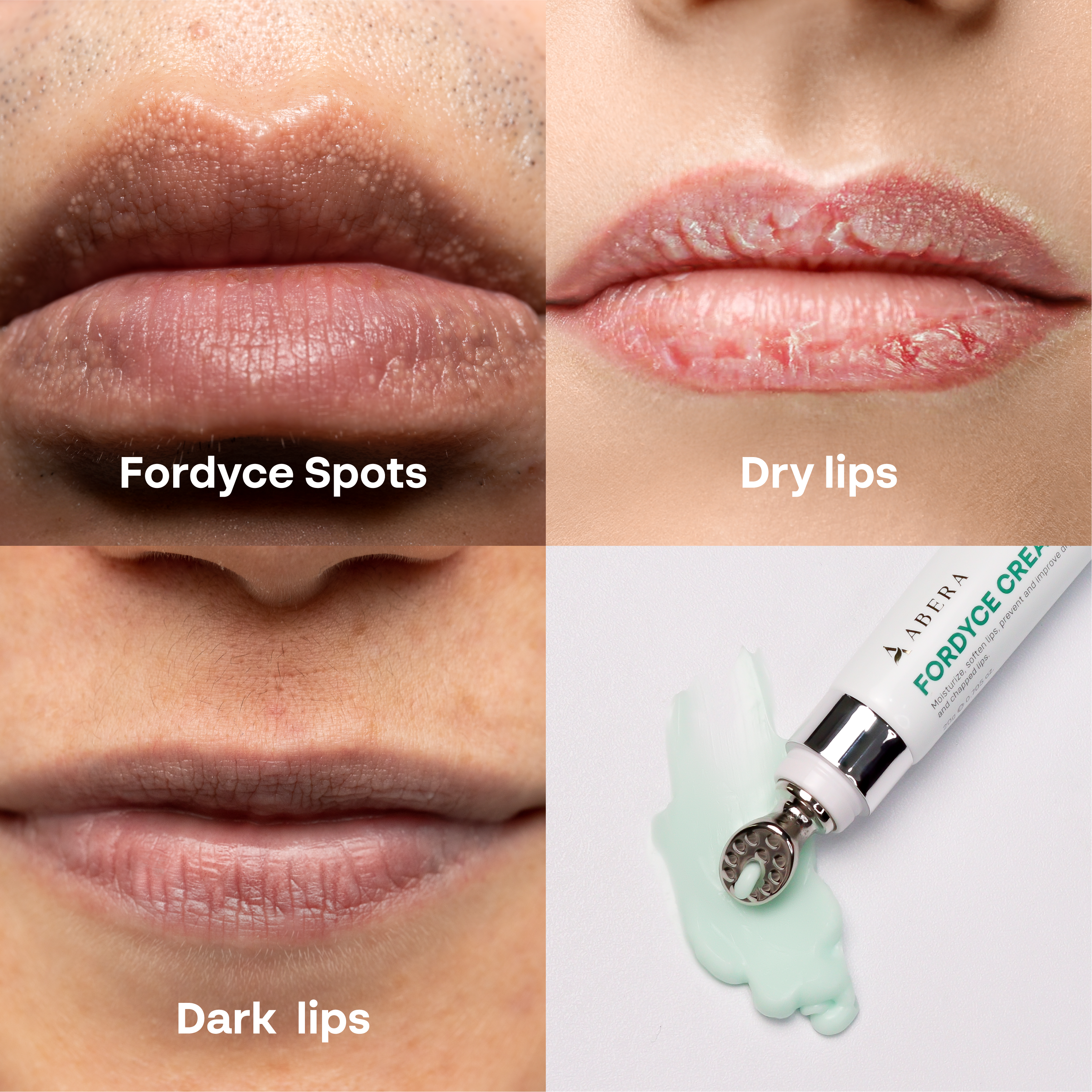 Abera Fordyce Lip Cream