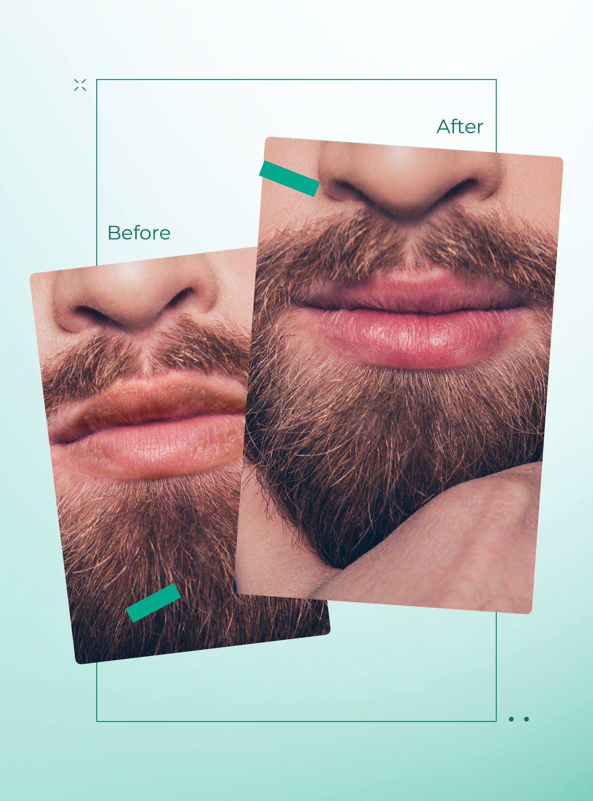 Abera Fordyce Spot & Dark Lip Care Set – Smooth Lip Appearance & Moisture Support with Botanical Extracts & Vitamins