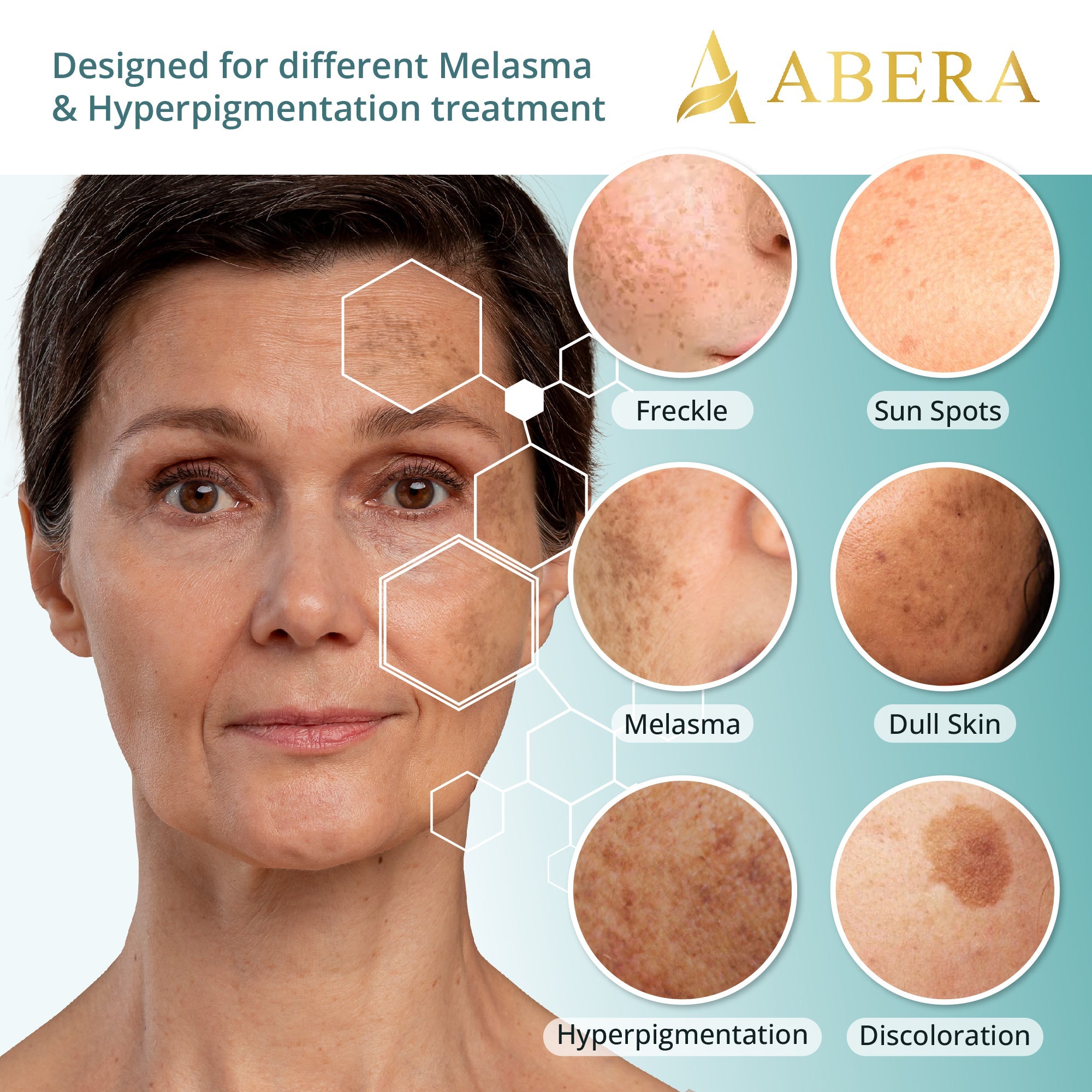 ABERA Melasma Serum Treatment 20ml