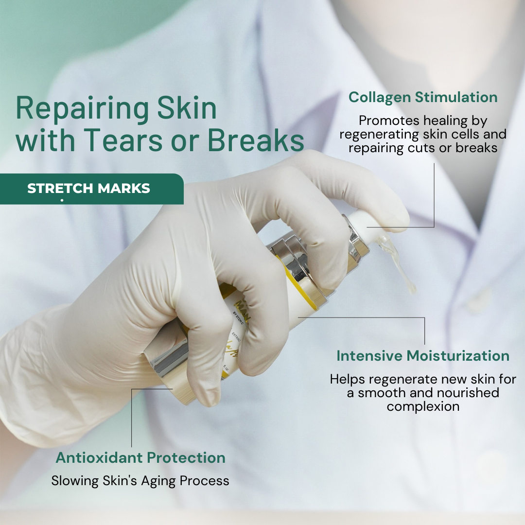 Belani Stretch Marks For Regnancy