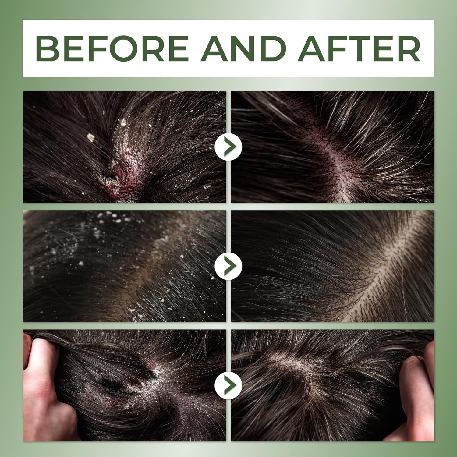 ABERA Powerful Anti-Dandruff Shampoo